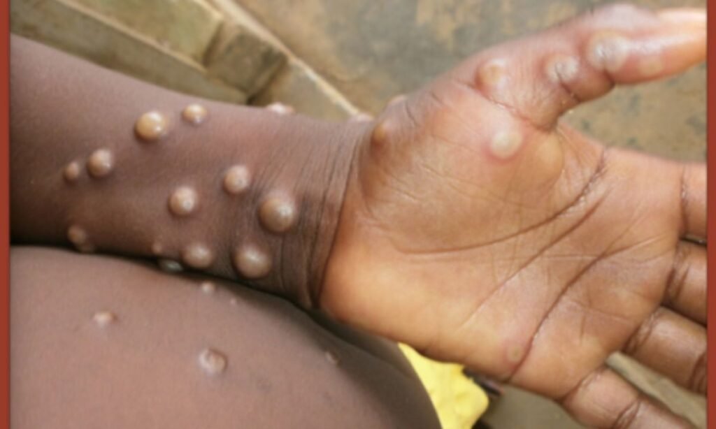 Monkeypox case in Kerala